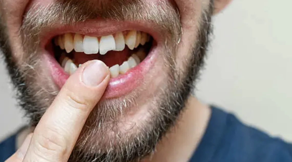 Chipped Tooth Repair in Louisville, KY