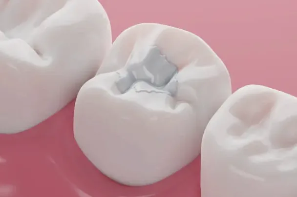 Dental Fillings in Louisville, KY