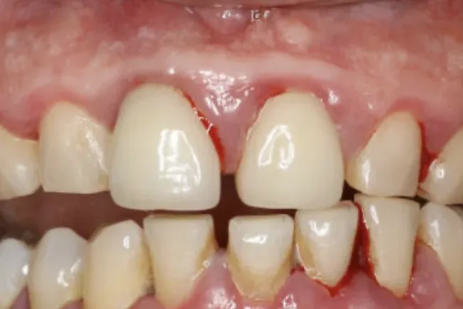 Gum Disease Treatment in Louisville, KY